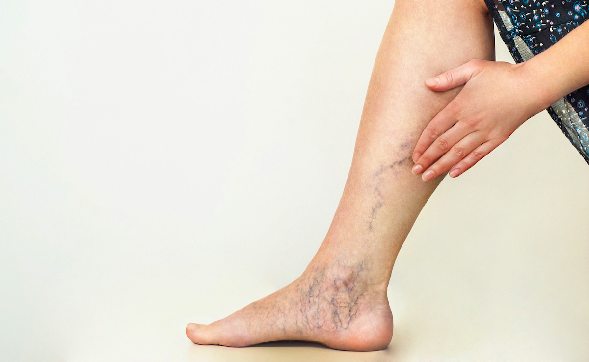 Working from home increased the cases of varicose veins at an early age!