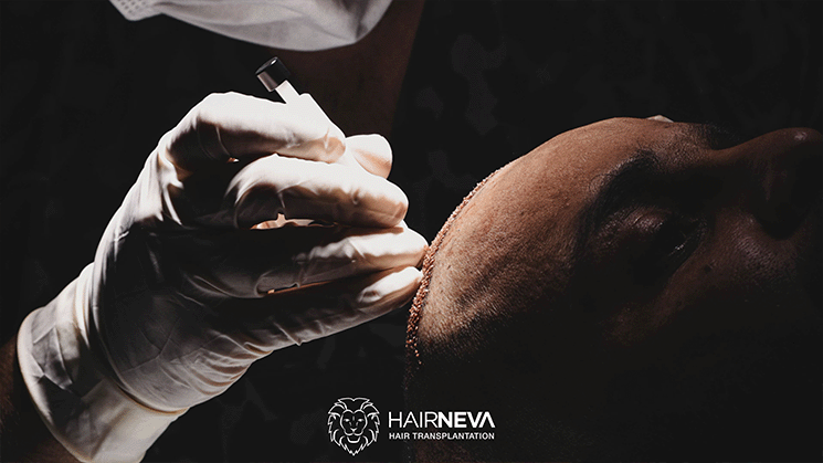 HairNeva introduces DHI technique for natural hair transplantation