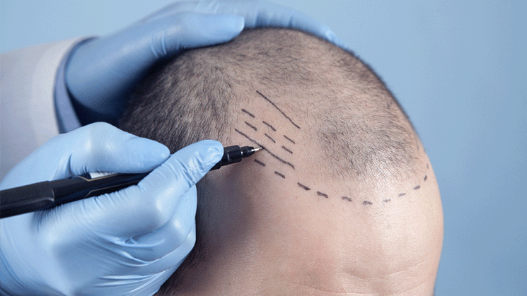 Expert Explanation: “Hair transplantation procedures now take less time with innovative technology.”