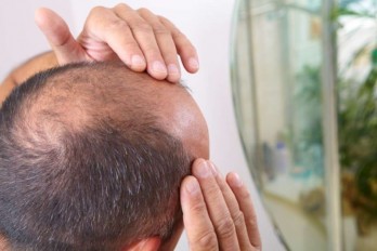 What should be considered in hair transplant?