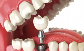 Fear of dental treatment can lead to cancer