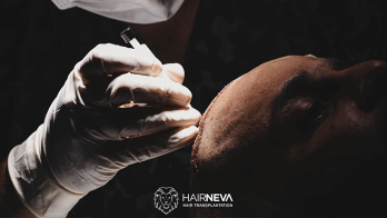 HairNeva introduces DHI technique for natural hair transplantation