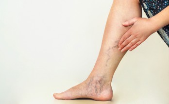 Working from home increased the cases of varicose veins at an early age!